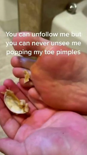 Huge blackheads new 2022 - Blackheads new this week tweezers