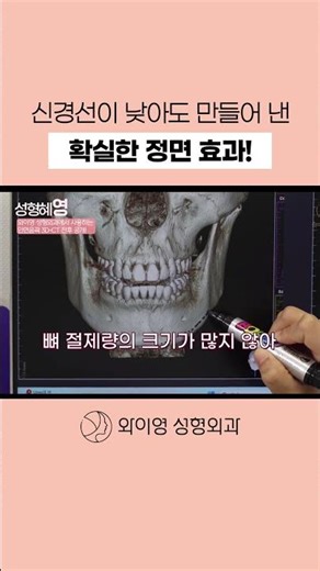 신경선이 낮아도 안전하게! 3D-CT로 확인 후 피질골 절제로 정면효과까지