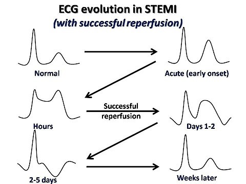 ECG course: ECG in STEMI, Dr. Sherif Altoukhy