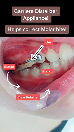 Carriere Distalizer! My Favorite! Ask Qs!! #loewandpatelortho #fyp #foryou #foryoupage #foryourpage #tiktok #orthodontist #braces #carriere #bite