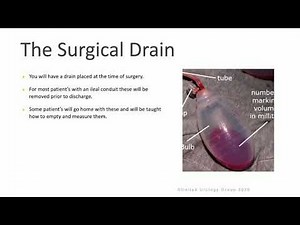 Radical Cystectomy for Bladder Cancer in Women