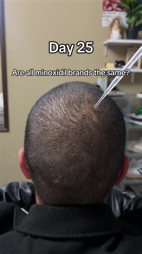 25 Days of Using Minoxidil for Hair Growth