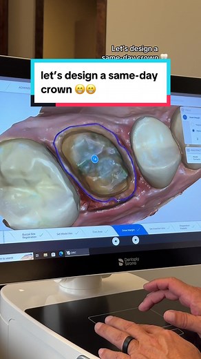 Design a Same-Day Crown with Me! 🦷