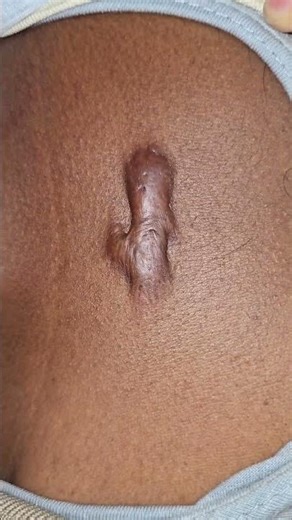 Keloid over sternum