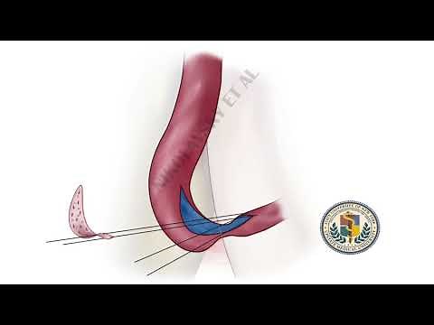 membranous (sphincteric) urethroplasty animation: dorsal onlay BMG