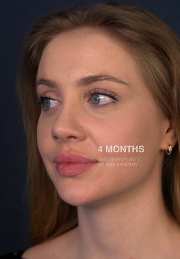 Nose Changes Everything with Rhinoplasty Before and After