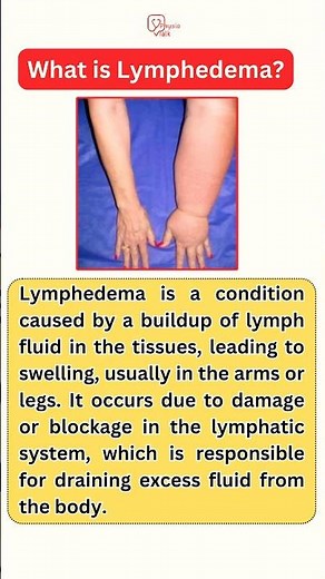 What is lymphedema and how it is treated? #shortsfeed #lymphedema #lymphaticmassage