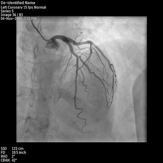 LAO CRA View Showing LM, LAD & LCx | Cineangiography
