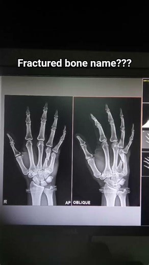 xray rt hand ap oblique/// #xray #fractured #medicalimaging #hospital #radiography