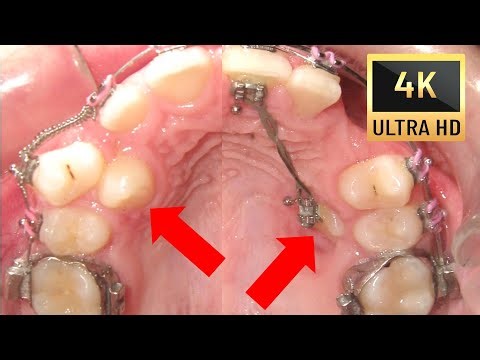 🤔 An Awful IMPACTED canine. The journey to PERFECT SMILE😊: Before and After of Transpositions - 4K!