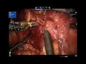 Robotic-Assisted Partial Nephrectomy In Case Of Single Kidney • Video • MEDtube.net