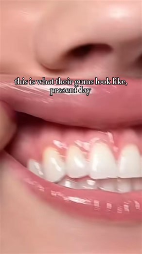 Studies show that gum disease affects over 2.6 billion people worldwide — and harsh toothbrushes are one of the leading causes of gum irritation and recession. The Selene NanoBrush solves that. Its 10,000 ultra-soft nano bristles clean deep beneath the gumline without damage — removing bacteria, improving blood flow, and restoring gum health. 💚 Protect your gums. Prevent recession. Reverse early gum disease — with the NanoBrush. | SeleneTeeth