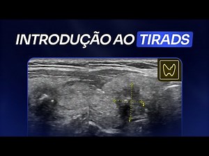 TIRADS: guia completo para Nódulos da Tireoide | Escola de Ultrassom