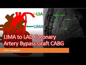 LIMA to LAD Coronary Artery Bypass Graft CABG