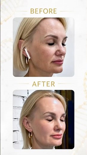 How exosomes work in skin #exosometherapy #skincare
