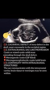 101 reactions · 17 shares | Encephalocele is a neural tube defect characterized by sac-like protrusions of the brain and the membranes that cover it through openings in the skull #fetalmedicine #fetalultrasound #FetalAnomalyScan | Sana Kashif | Facebook