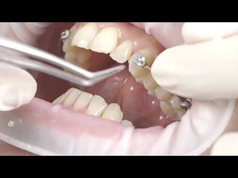 Carriere® Motion ™ Clase II vídeo de colocación