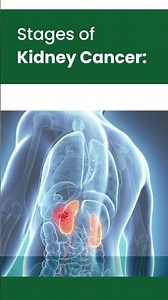 Kidney Cancer Causes & Stages