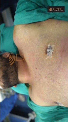 Gynecomastia Surgery