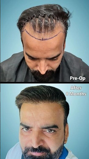 Unshaven Long Hair Transplant Result Delhi | Unshaven Hair Transplant in Delhi #shortsfeed