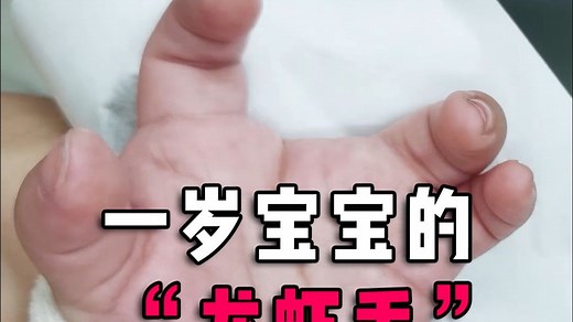 一岁宝宝的“龙虾手”