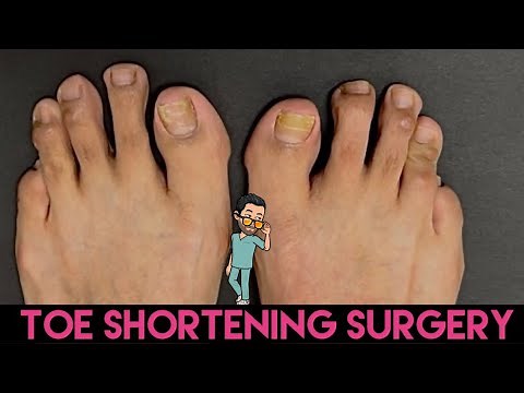 MINIMALLY INVASIVE TOE SHORTENING SURGERY ** BEFORE & AFTER PICTURES