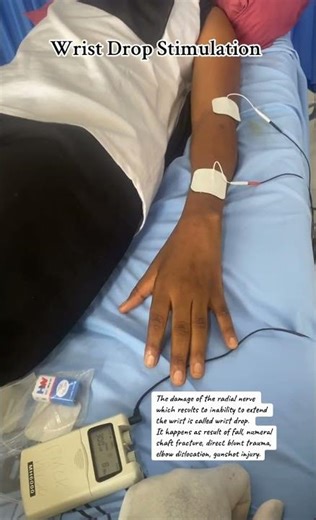 WRIST DROP STIMULATION; Proper electrode placement #health #physiotherapy #fyp #physicaltherapy