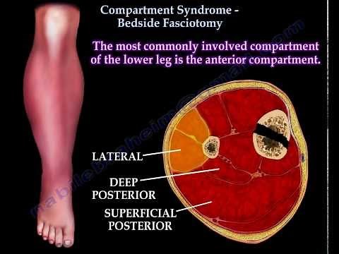 Compartment Syndrome , bedside Fasciotomy - Everything You Need To Know - Dr. Nabil Ebraheim