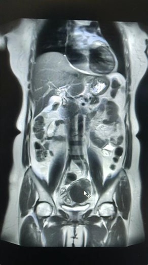 MRI of Whole Abdomen #mri #mritutorial #mriscan #mriplanning #radiology
