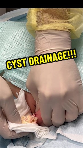 Understanding Why Some Cysts Become Very Large