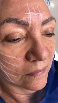 Fios faciais (Fios PDO) e biosestimulador - CiR harmonização facial