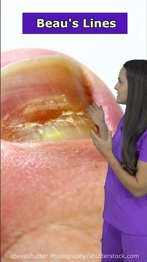 These NAIL Problems Could Be Health WARNING SIGNS #shorts