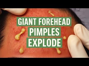 Giant Forehead Pimples EXPLODE! Brutal Yet Satisfying ASMR Removal