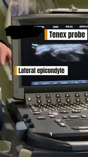 Tenex for Lateral Epicondylitis: Minimally Invasive Treatment for Tennis Elbow