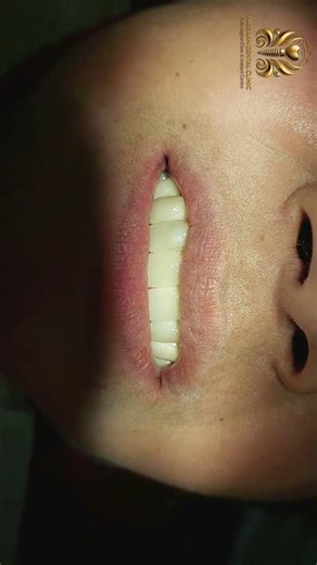 Basal Implants Before After | Zirconia Crowns | 72 Hours Smile Transformation