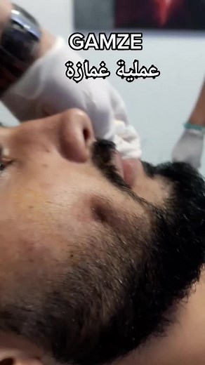 عمليات الغمازه في العالم العربي