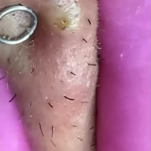 Pickel Ausdrücken Spa: Mitesser entfernen - Vorher/Nachher #shorts