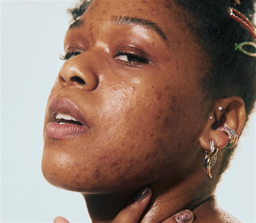 One Dab of This Gentle Spot Treatment Makes My Pimple Go Away Overnight