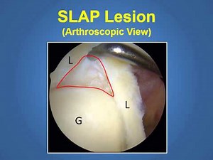 Overview of SLAP Tears in Shoulder from a Phoenix Orthopedic Surgeon (480)219-3342