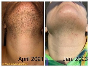 127 Hours: Recap of my ENTIRE electrolysis permanent facial hair removal | PCOS & Hirsutism support