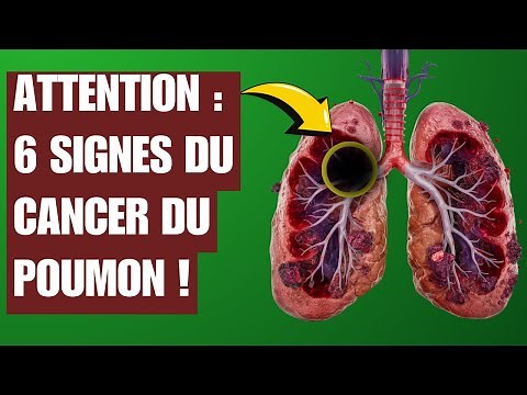 Détectez les 6 Signes de Cancer du Poumon AVANT qu'il Ne Soit Trop Tard ! 🚨👀 #Santé #Cancer