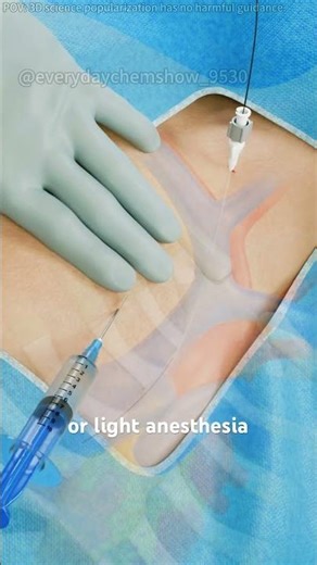 Bronchoscopy Procedure For Lung Biopsy#lungbiopsy #lungbiopsyrecovery #lungbiopsies