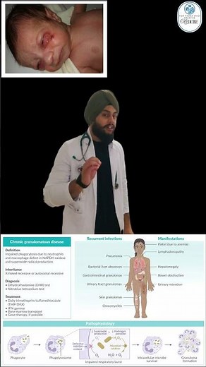 Chronic Granulomatous Disease #medmint #medicalstudent #medicine #education
