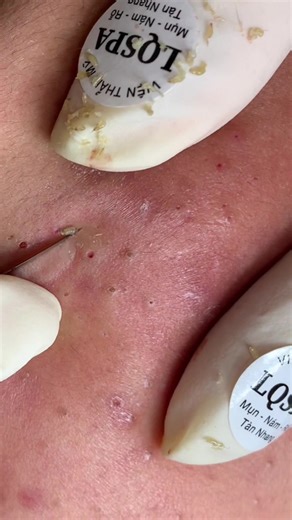 Kệ lun #chamsocdamun#chamsocdaseo#chamsocdanam#tanbinh#Lqspa&academy | Spa