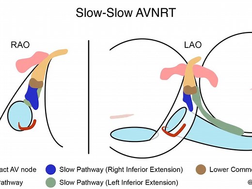 AVNRT - Ablation Targets