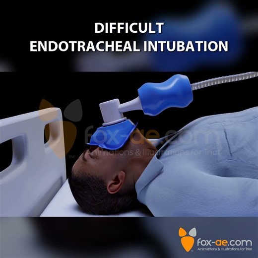 How Computer-Generated Animations Influence Jurors | Difficult Intubation Case