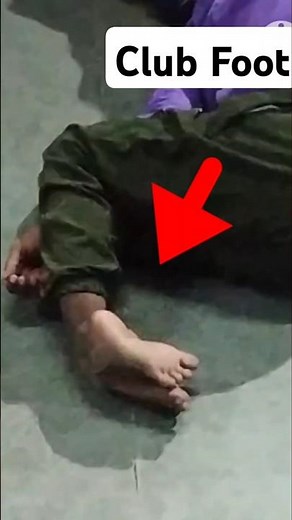 Club foot- causes, types and treatment