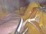 Laparoscopic Sleeve Gastrectomy: Step-By-Step Guide • Video • MEDtube.net