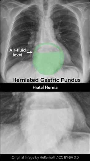 Hiatal Hernia Chest X-ray #shorts