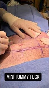 Botched Gynecomastia Surgery? Fixed! Lipo, Skin Tightening, Nipple Lift, Fat Grafting, Tummy Tuck